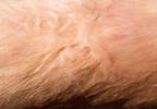 Improving Outcomes of Peripheral Nerve Surgery Improving Outcomes of Peripheral Nerve Surgery