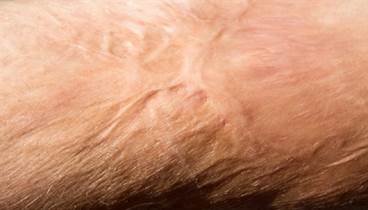 Improving Outcomes of Peripheral Nerve Surgery Improving Outcomes of Peripheral Nerve Surgery