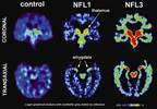 CTE Confirmed With Antemortem PET Imaging, Autopsy in Professional Football Player CTE Confirmed With Antemortem PET Imaging, Autopsy in Professional Football Player