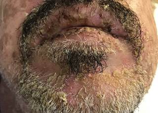 It is not clear what mechanism is at work in the association between the drugs and skin reactions. It is not clear what mechanism is at work in the association between the drugs and skin reactions.