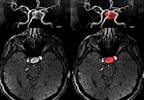 Bone Mineral Density Associated With Intracranial Aneurysm Presence, Size Bone Mineral Density Associated With Intracranial Aneurysm Presence, Size