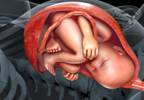 Psychostimulants in Pregnancy Associated With Increased Risk of Preeclampsia, Preterm Birth Psychostimulants in Pregnancy Associated With Increased Risk of Preeclampsia, Preterm Birth