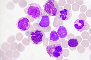 Four cases were associated with agranulocytosis, 2 had no white blood cell counts available and 1 had a high white blood cell count. Four cases were associated with agranulocytosis, 2 had no white blood cell counts available and 1 had a high white blood cell count.