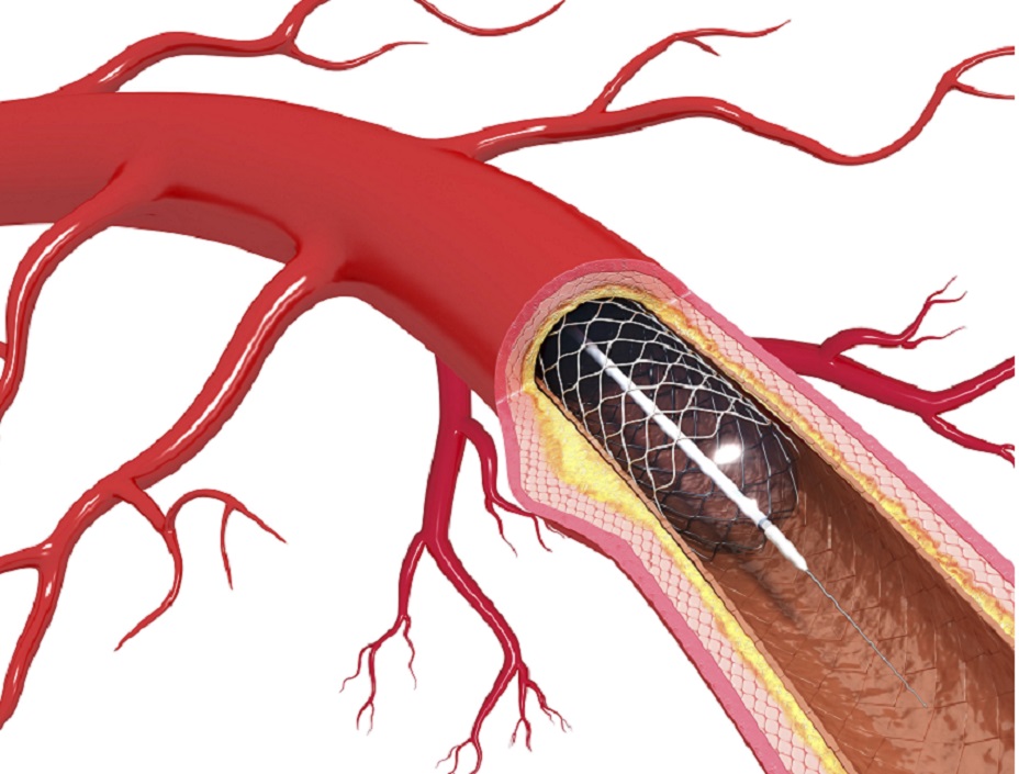 Percutaneous Transluminal Angioplasty Shown To Be Ineffective In Ms