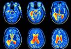 Alterations in Cerebral Morphometrics Can Help Identify ADHD Alterations in Cerebral Morphometrics Can Help Identify ADHD