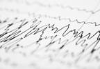EEG Changes in Pediatric BECTS Promoted by Treatment With Levetiracetam, Sulthiame EEG Changes in Pediatric BECTS Promoted by Treatment With Levetiracetam, Sulthiame