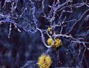 Obstructive Sleep Apnea May Increase Amyloid Burden Obstructive Sleep Apnea May Increase Amyloid Burden