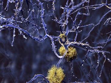 Exercise May Delay Symptoms of Alzheimer's in Those at Risk Exercise May Delay Symptoms of Alzheimer's in Those at Risk