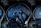 Examining the Potential of Neuroanatomical Imaging Signature for Schizophrenia Biomarkers Examining the Potential of Neuroanatomical Imaging Signature for Schizophrenia Biomarkers