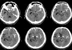 Induced Hypertension Does Not Improve Outcomes in Subarachnoid Hemorrhage, Cerebral Ischemia Induced Hypertension Does Not Improve Outcomes in Subarachnoid Hemorrhage, Cerebral Ischemia