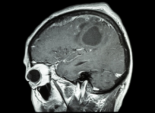 Vomiting, headache history, and seizures may be clinical signs associated with malignant brain neoplasms in pediatric patients. Vomiting, headache history, and seizures may be clinical signs associated with malignant brain neoplasms in pediatric patients.