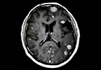 Nivolumab + Ipilimumab Shows Efficacy for Untreated Brain Mets Nivolumab + Ipilimumab Shows Efficacy for Untreated Brain Mets