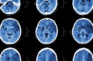 Several studies showed that PPAR-γ agonists reduced the risk for recurrent stroke when compared with placebo. Several studies showed that PPAR-γ agonists reduced the risk for recurrent stroke when compared with placebo.