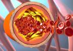Intracranial Atherosclerotic Disease May Coexist With Stroke Risk Factors Intracranial Atherosclerotic Disease May Coexist With Stroke Risk Factors