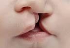 High Doses of Topiramate for Epilepsy in Pregnancy Increase Risks for Oral Clefts in Offspring High Doses of Topiramate for Epilepsy in Pregnancy Increase Risks for Oral Clefts in Offspring