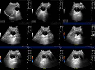 Individuals were categorized based on the presence of single or multiple renal cysts; those with multiple cysts had higher odds of having a stroke. Individuals were categorized based on the presence of single or multiple renal cysts; those with multiple cysts had higher odds of having a stroke.
