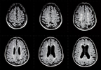 Apheresis Associated With Clinical Improvement in Early Active Multiple Sclerosis Apheresis Associated With Clinical Improvement in Early Active Multiple Sclerosis