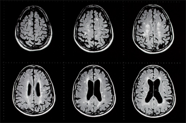 Certain Sites of Brain Lesions in MS Tied to Bowel Incontinence Certain Sites of Brain Lesions in MS Tied to Bowel Incontinence