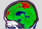 Risk Factors Have Varying Effects on Stroke Pathology Risk Factors Have Varying Effects on Stroke Pathology