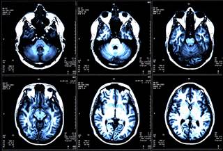 Participants in both treatment groups underwent a brain MRI to view cortical thickness. Participants in both treatment groups underwent a brain MRI to view cortical thickness.