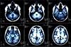 Persistent Posttraumatic Headache Is Associated With Reduced Cortical Thickness Persistent Posttraumatic Headache Is Associated With Reduced Cortical Thickness