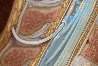 dipyridamole breast cancer