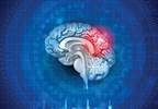 Traumatic Brain Injury Associated With Increased Dementia Risk Traumatic Brain Injury Associated With Increased Dementia Risk