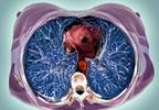 Restless Legs Syndrome Associated With Increased Cardiovascular Mortality Restless Legs Syndrome Associated With Increased Cardiovascular Mortality