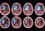 Intracerebral Hemorrhage-Related Hospital Mortality Reduced With Prior NOAC Use Intracerebral Hemorrhage-Related Hospital Mortality Reduced With Prior NOAC Use