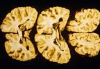 Negative Fateful Life Events Linked to Advanced Brain Aging Negative Fateful Life Events Linked to Advanced Brain Aging