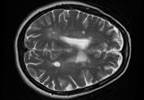 Siponimod Reduces Disability Progression in Secondary Progressive Multiple Sclerosis Siponimod Reduces Disability Progression in Secondary Progressive Multiple Sclerosis