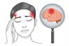 Stroke in Women: Risk, Prevention, and Treatment Stroke in Women: Risk, Prevention, and Treatment