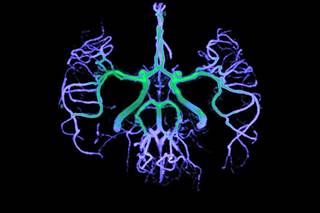 Features of reversible cerebral vasoconstriction syndrome include diffuse segmental constriction of cerebral arteries and thunderclap headache. Features of reversible cerebral vasoconstriction syndrome include diffuse segmental constriction of cerebral arteries and thunderclap headache.