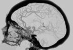 No Reduction in Cerebral Perfusion With Intensive Blood Pressure Lowering No Reduction in Cerebral Perfusion With Intensive Blood Pressure Lowering