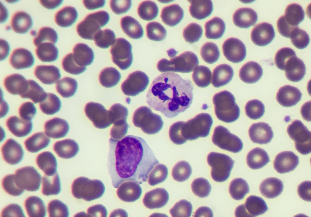 Low Relative Lymphocyte Count Associated With Higher