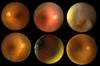 Predicting Stroke Subtype Risk With Retinal Microvascular Abnormalities Predicting Stroke Subtype Risk With Retinal Microvascular Abnormalities