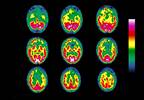 Frontotemporal Dementia, Frontotemporal Lobar Degeneration Symptoms More Common Later in Life Frontotemporal Dementia, Frontotemporal Lobar Degeneration Symptoms More Common Later in Life