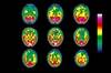 Functional Imaging in Movement Disorders: Diagnostic Advantages Functional Imaging in Movement Disorders: Diagnostic Advantages