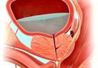 Idiopathic Parkinson Disease May Increase Risk for Overactive Bladder Idiopathic Parkinson Disease May Increase Risk for Overactive Bladder