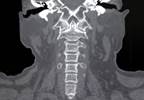No Benefit for MRI After Normal Cervical CT in Blunt Trauma No Benefit for MRI After Normal Cervical CT in Blunt Trauma