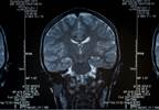 Reduced Cortical Thickness ID'd in Obstructive Sleep Apnea Reduced Cortical Thickness ID'd in Obstructive Sleep Apnea