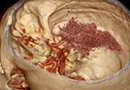 Predicting Intracerebral Hemorrhage Outcomes With Peak Perihemorrhagic Edema Predicting Intracerebral Hemorrhage Outcomes With Peak Perihemorrhagic Edema