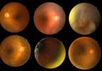 Retinopathy Associated With Greater Risk for 20-Year Cognitive Decline Retinopathy Associated With Greater Risk for 20-Year Cognitive Decline