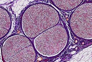 The chance of tonic spasms increases 22 times in patients with neuromyelitis optica spectrum disorders. The chance of tonic spasms increases 22 times in patients with neuromyelitis optica spectrum disorders.