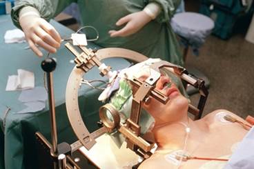 Neurosurgery in Parkinson Disease: A Brief History and Look Forward Neurosurgery in Parkinson Disease: A Brief History and Look Forward