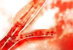 Successful Reperfusion Linked to Reduced Edema in Acute Ischemic Stroke Successful Reperfusion Linked to Reduced Edema in Acute Ischemic Stroke
