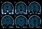 Fingolimod May Help Prevent Brain Volume Loss in Relapsing-Remitting Multiple Sclerosis Fingolimod May Help Prevent Brain Volume Loss in Relapsing-Remitting Multiple Sclerosis