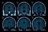 Fingolimod May Help Prevent Brain Volume Loss in Relapsing-Remitting Multiple Sclerosis Fingolimod May Help Prevent Brain Volume Loss in Relapsing-Remitting Multiple Sclerosis