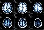 Cardiovascular Comorbidities Linked to Increased Brain Atrophy in Multiple Sclerosis Cardiovascular Comorbidities Linked to Increased Brain Atrophy in Multiple Sclerosis