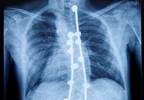 Scoliosis Surgery Found Beneficial for Cerebral Palsy Patients Scoliosis Surgery Found Beneficial for Cerebral Palsy Patients